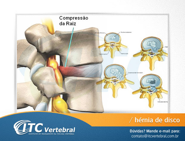 hernia-de-disco-cirurgia Hérnia de Disco cirurgia