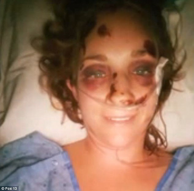 Recovering: Kohnhurst fractured her back in three places, crushed her pelvis and broke her nose