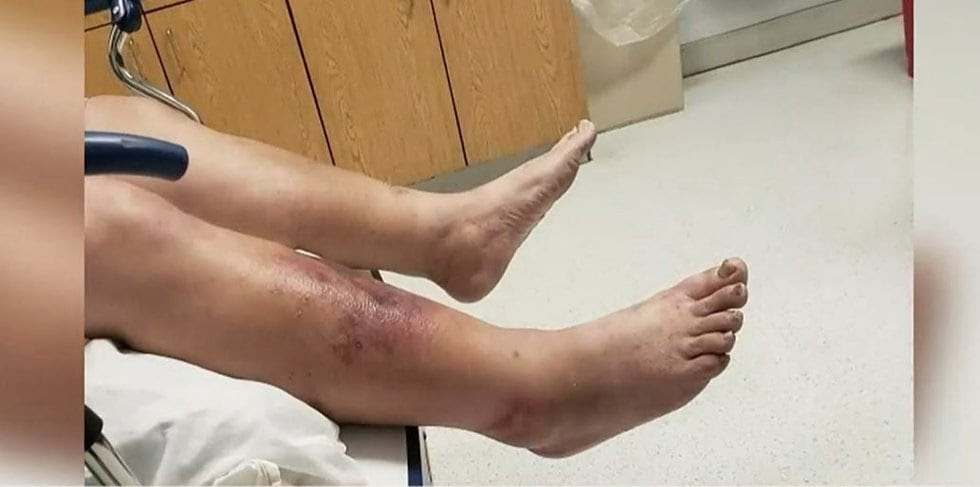 Man fighting for life in ICU after contracting flesh-eating bacteria on Gulf coast
