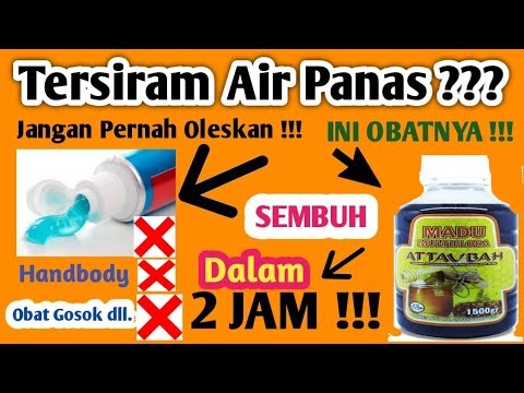 Tangan Terkena Air Panas / Ubat Melecur Terkena Air Panas  J Kosong r