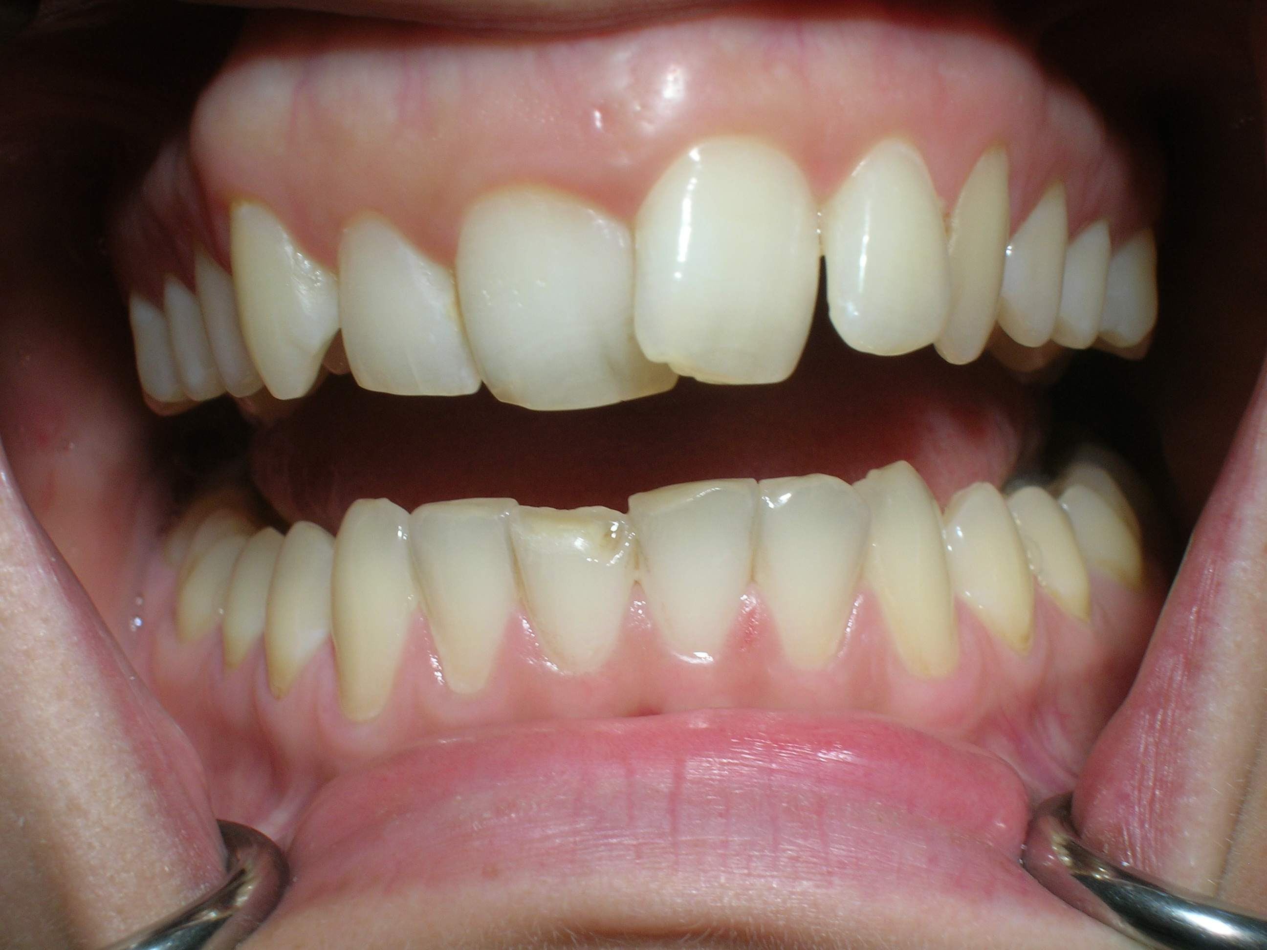 J Ai Les Dents Qui Se Déchaussent Que Faire Tout Faire
