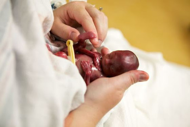 photo of 25 week old fetus Libby Quotes