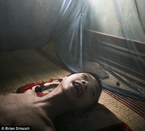  Suffering from a distorted reality, Nguyen Tran Ho, 11, gazes out from his bed at home in the Phuong Son district, Nha Trang