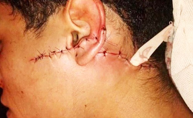 Stitched up: The man has been left with a huge scar from where surgeons stitched his face back together