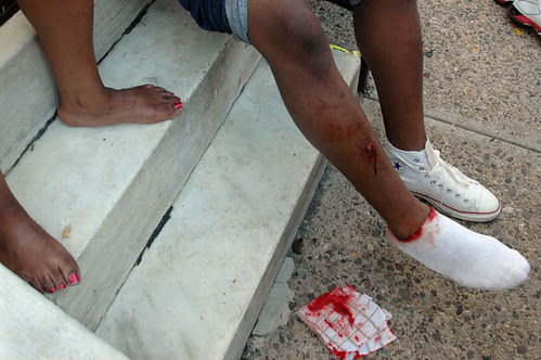 gunshot wound in leg cropped_1 web.jpg