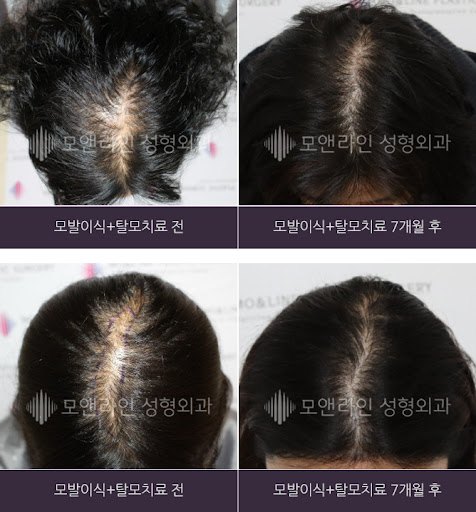 여성 탈모치료? 모낭 기능을 회복하는 방법