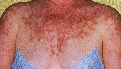 Top 10 Diseases That Cannot Be Cured 0712 e1312899849477 Top 10 Diseases That Cannot Be Cured