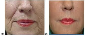 sculptra - Buscar con Google