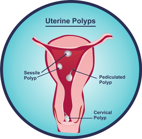 Cervical Polyp treatment - jualitapomsiblog