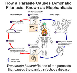 How a parasite causes lymphatic filariasis, known as elephantiasis