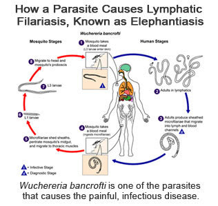 Infographic of the Week How a parasite causes lymphatic filariasis, known as elephantiasis
