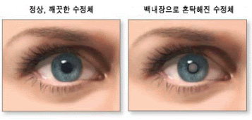 초기 백내장 증상의 6가지 원인 치료 수술 후 관리 2