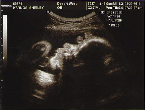 Ultrasound2011.03.30_03