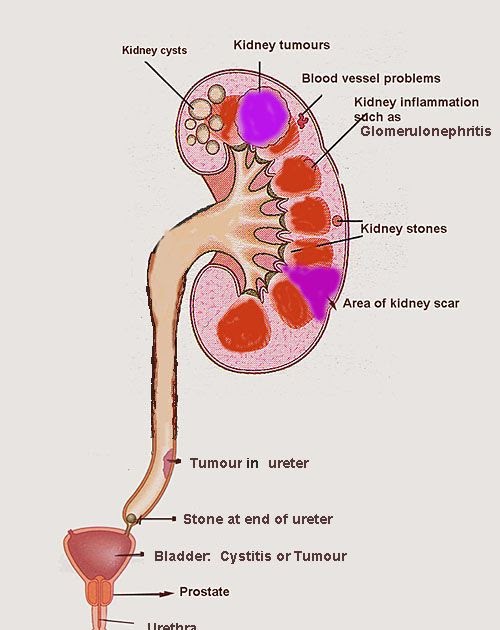 What Is Hematuria A Sign Of - Ronald Hall Bruidstaart