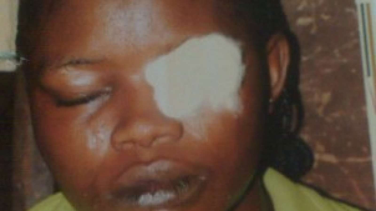 Woman Bites Off Friend's Eyelid (photo) 