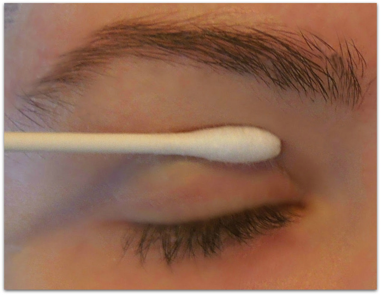 new-method-white-spots-on-eyelids-how-to-remove