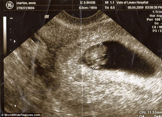 Ultrasound scans revealed that Anna's baby was thriving despite doctors fears it would worsen her condition