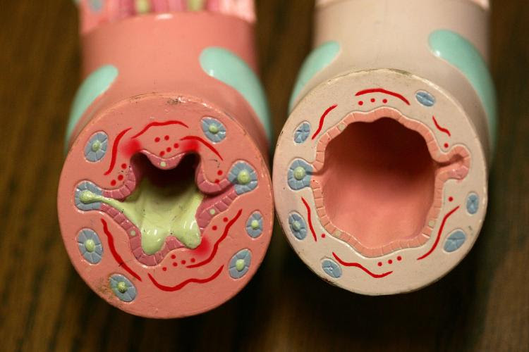 asthma asthma