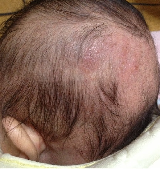 【ベストセレクション】 赤ちゃん 頭皮 湿疹 画像 トップ新しい画像