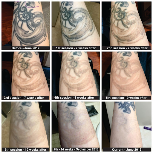 how-many-sessions-to-remove-tattoo-reddit-laser-tattoo-removal