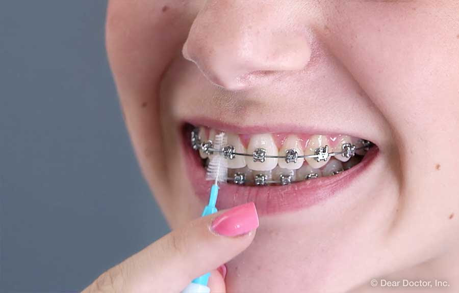 Forma Correcta De Lavarse Los Dientes Con Brackets - Formă Blog