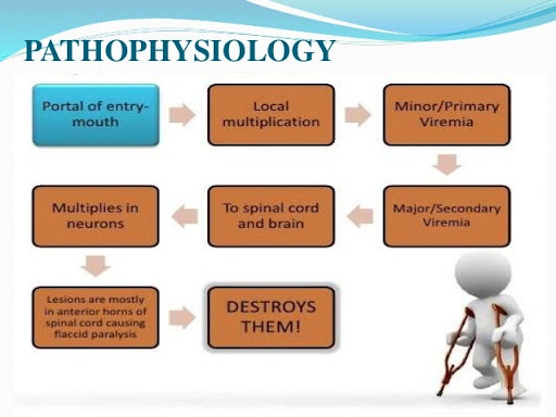 Poliomyelitis