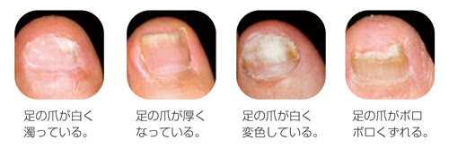 足 水虫 爪 初期症状