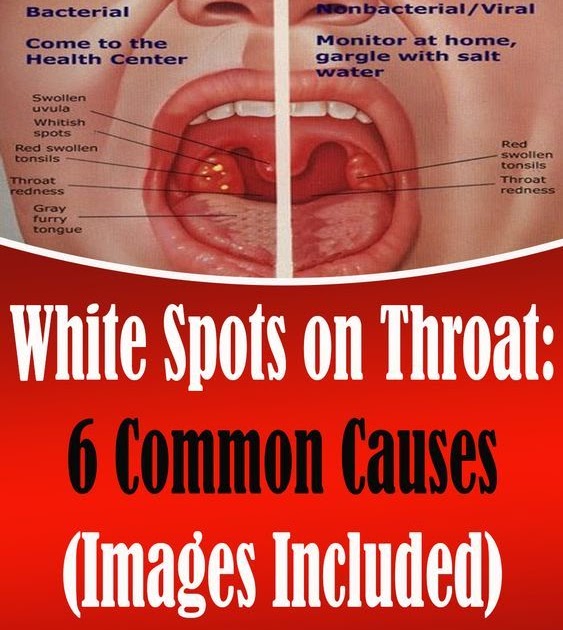 White Spots on Throat: 6 Common Causes (Images Included) - bleesingbeauty
