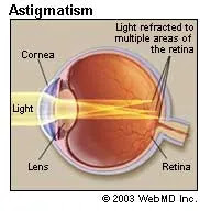 Astigmatism2