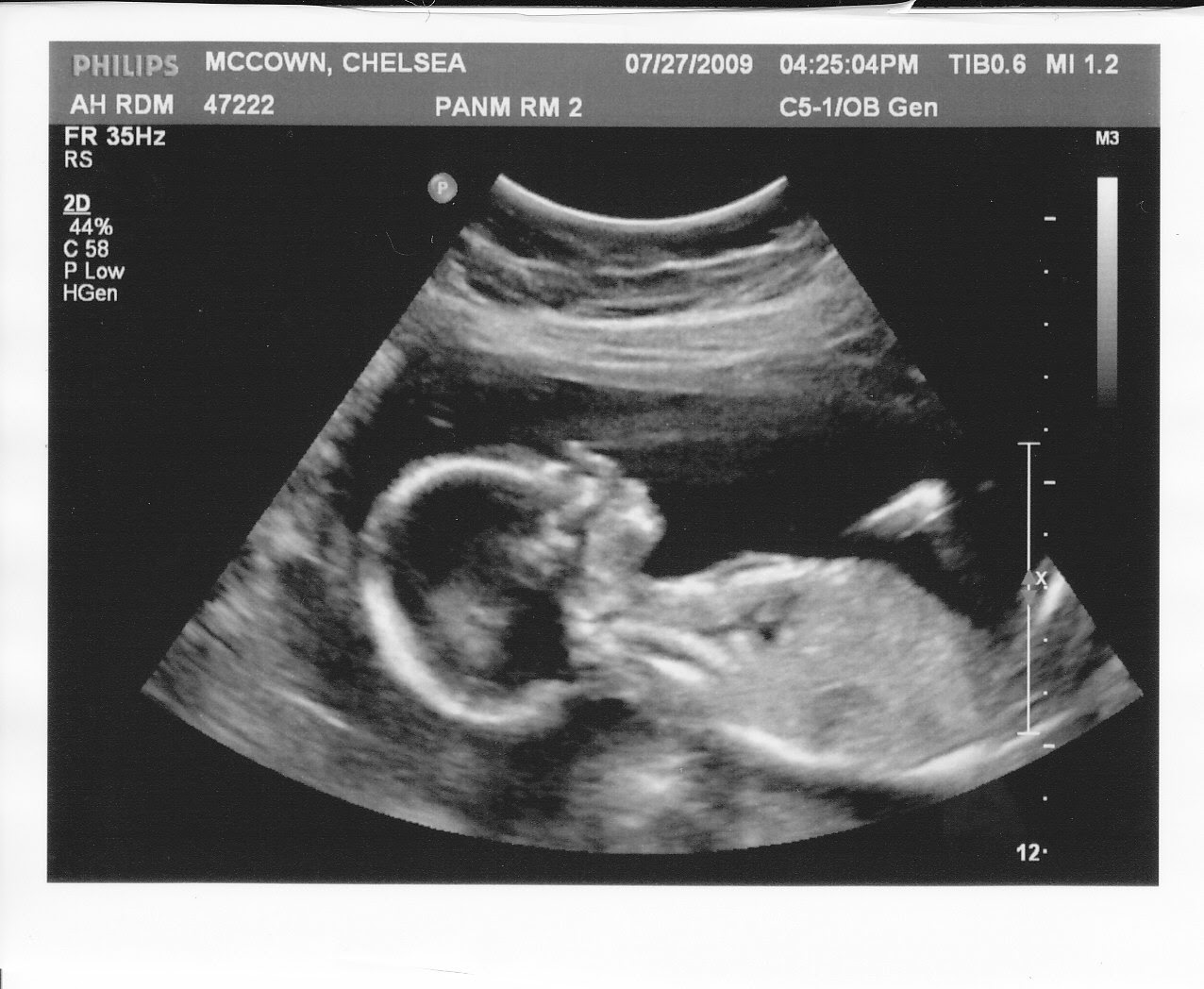 Liveatvoxpop 2 Month Ultrasound In Pregnancy