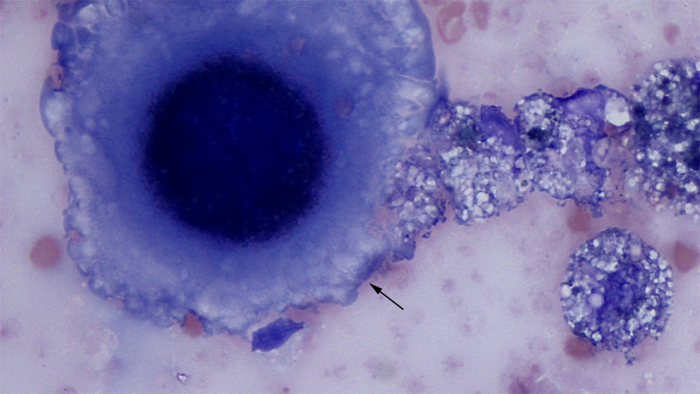 Mesothelioma Pleural Fluid Markers