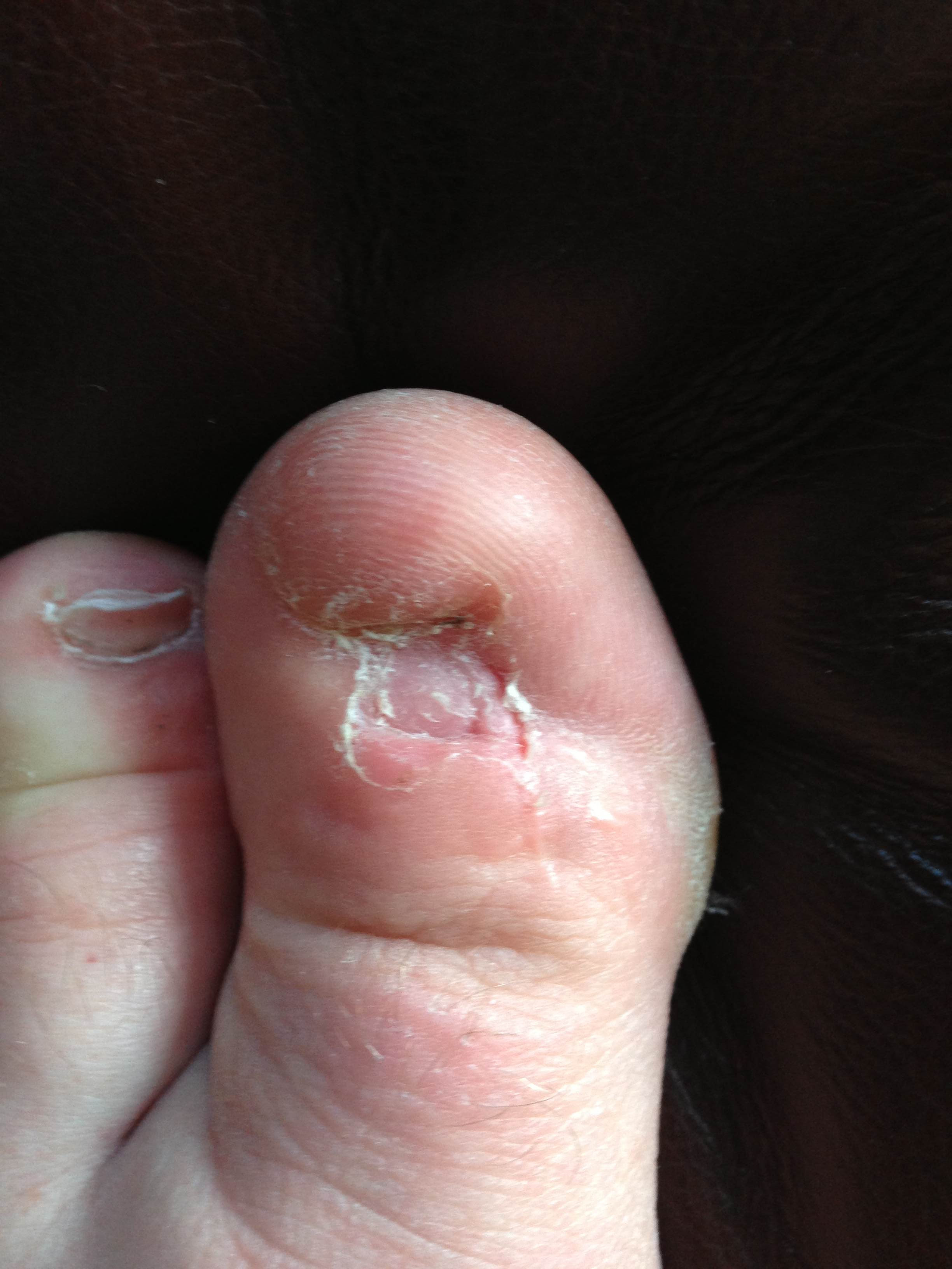 What it looks like to have no toe nails : WTF