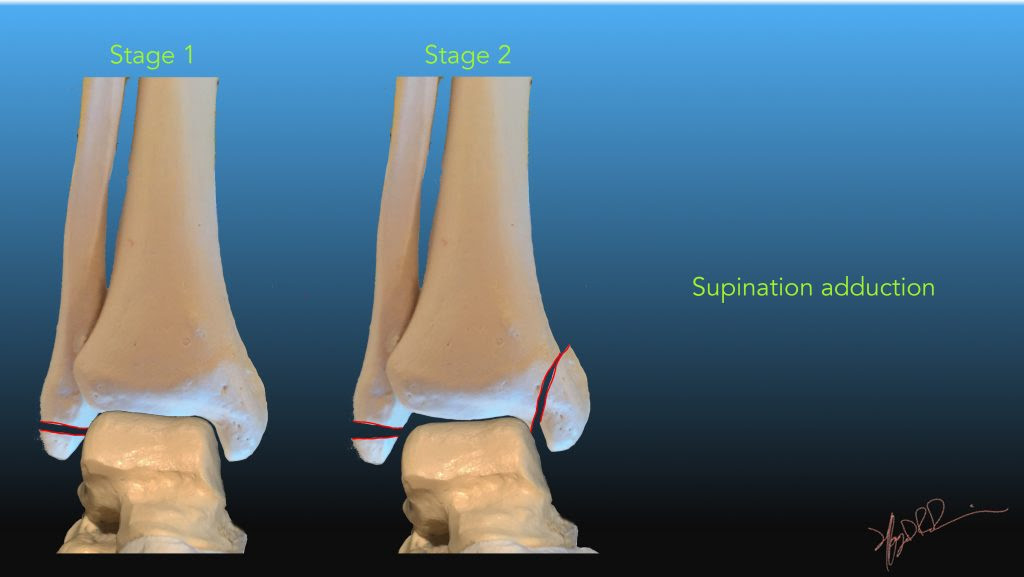 Lateral Tibial Plateau Fracture Icd 10 Code