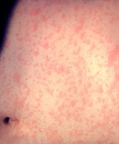 This is the skin of a patient after 3 days of measles infection.