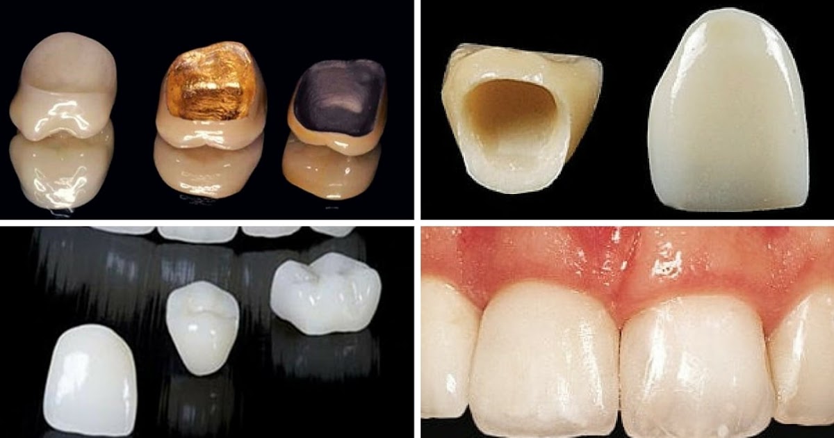 Crown Cost Without Insurance Gold Crown Tooth Cost And Comparison To