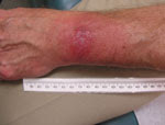 Thumbnail of Atypical erythema migrans lesion on a patient with PCR-positive result for Borrelia burgdorferi infection. The rash was not considered typical because it lacked central clearing and peripheral erythema. The differential diagnosis included a contact dermatitis and arthropod bite. At the initial examination, this patient was seronegative for B. burgdorferi by 2-tiered criteria. Three weeks after therapy, the patient had positive results for ELISA and IgM Western blot and negative resu