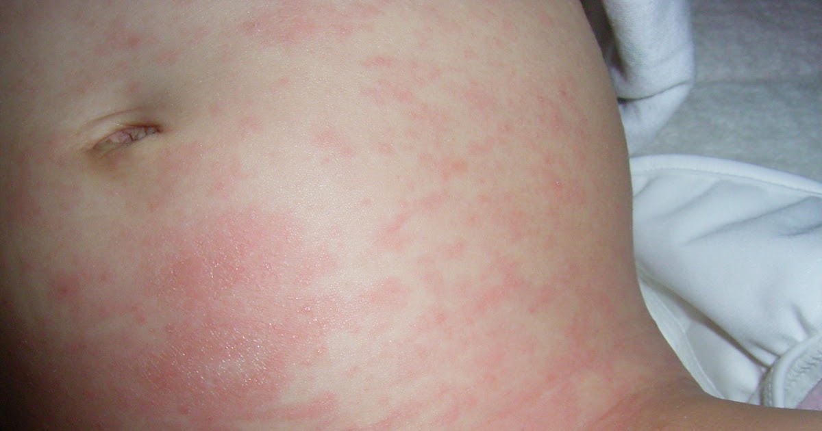 突発 性 発疹 湿疹