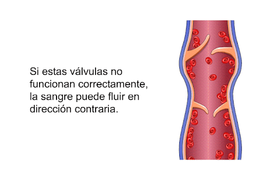 PatEdu.com : Várices y cirugía