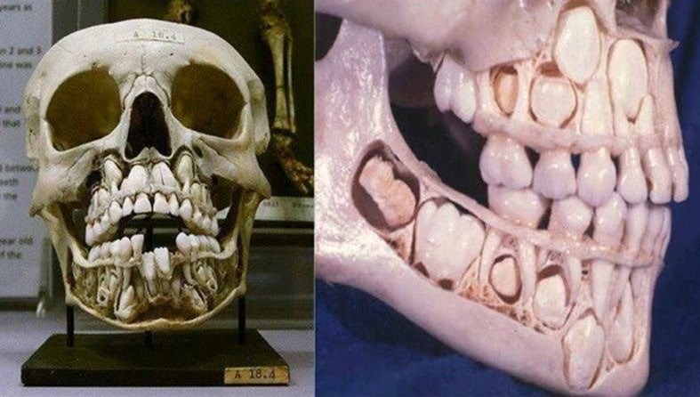 Childs Skull Before Losing Baby Teeth TeethWalls
