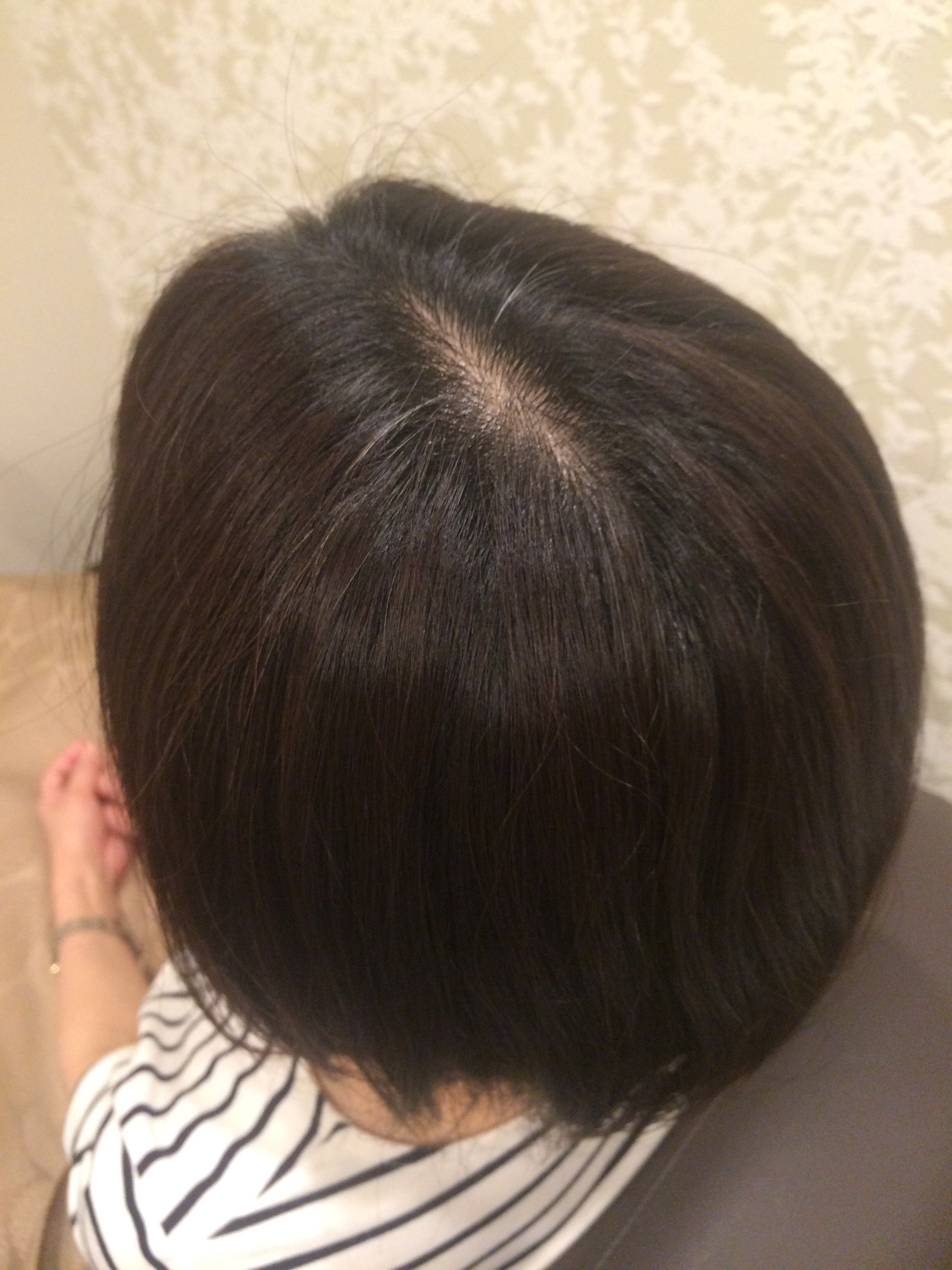 √ 後頭部 白髪 268890後頭部 白髪 抜き方