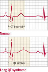 Borderline Normal Ecg : κ Agreement For No, Normal In Athletes 