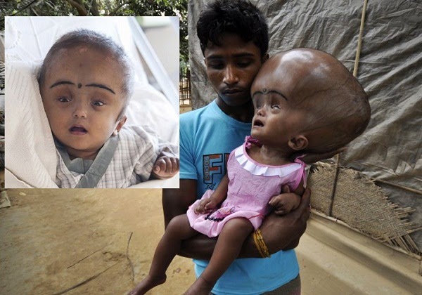 Alien Head Baby A Newborn With An Unusually Large Head Was Rescued By