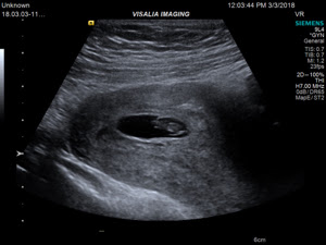 7 Weeks Pregnant Scan Heartbeat Hair Highlight Trends