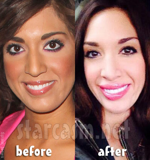 News Farrah Abraham Before And After Collagen Lip Injections Photos