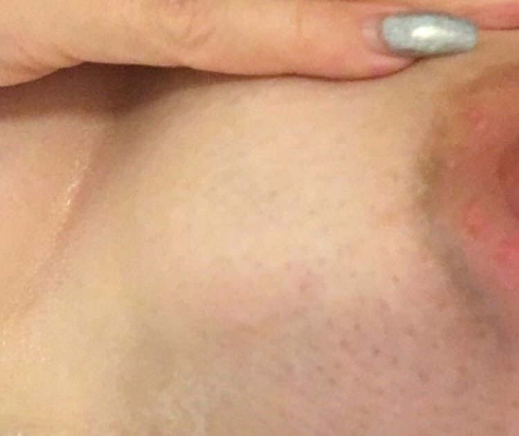Dark Ring Around Areola Sign Of Pregnancy Pregnancywalls