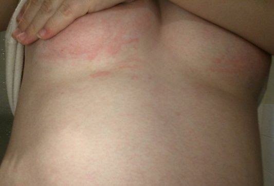 How To Get Rid Of A Rash Under Breasts