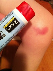 Zack's Bruise Cream