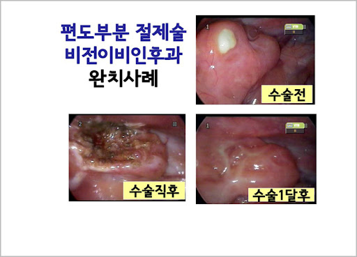 부산 설재수술 2차수술 안해도