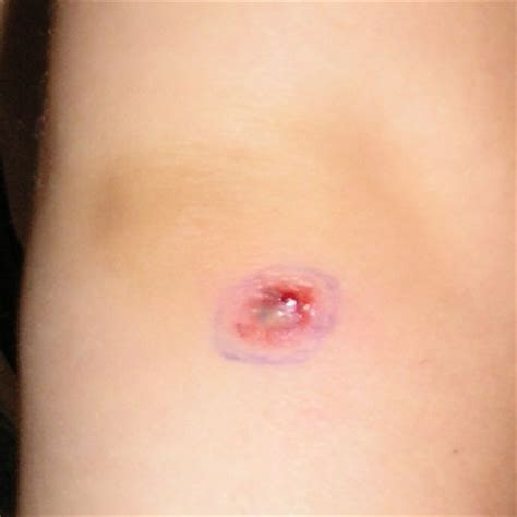 Spider bites that itch Spider bites that itch
