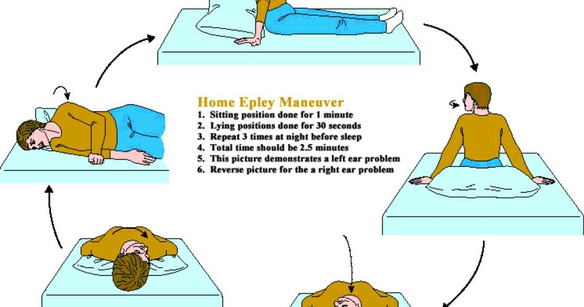 11+ Epley Maneuver At Home For Vertigo Exercises Png